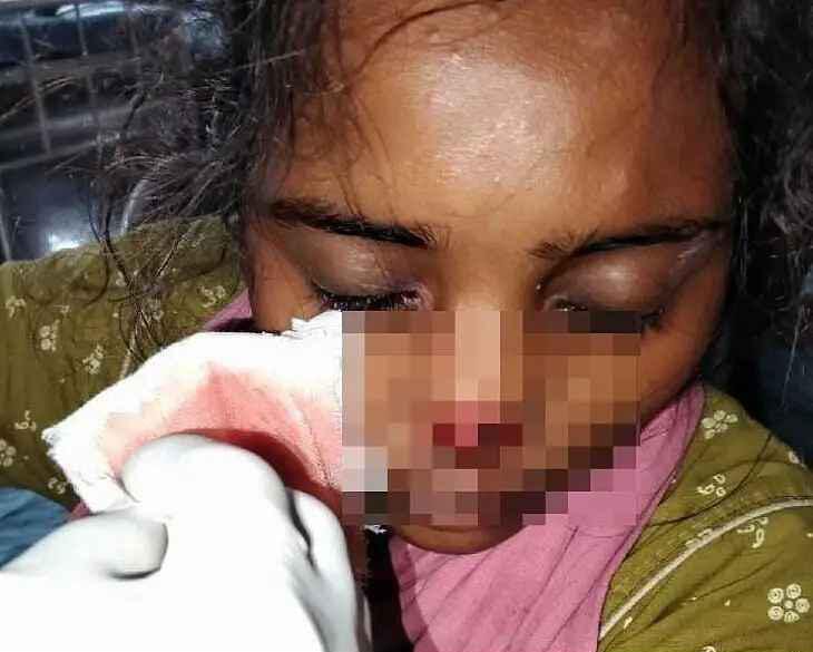 భార్య ముక్కు కొరికిన భర్త..
